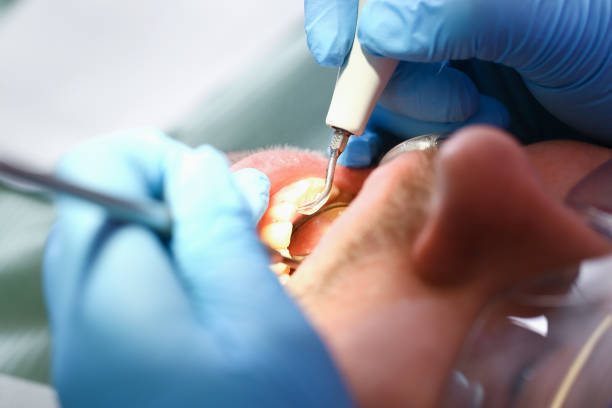Best Emergency Tooth Extraction in Twin Lakes, VA